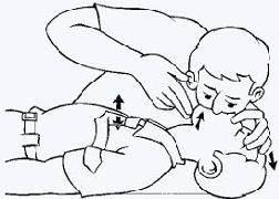reanimación cardio pulmonar
